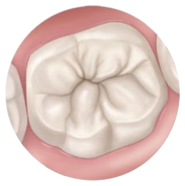Rendering of a tooth without sealant