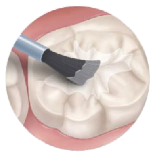 Rendering of a tooth as sealant is applied with a brush