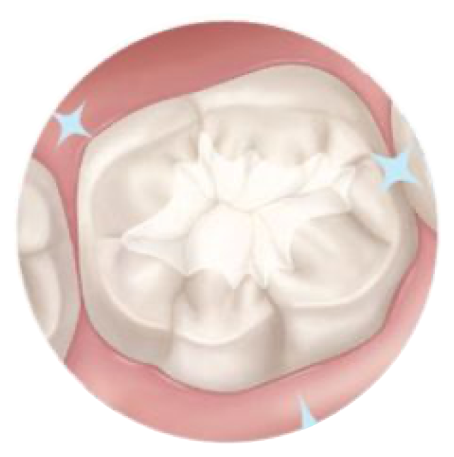 Rendering of a tooth after final sealant applied with a sparkling white area in the center of the tooth